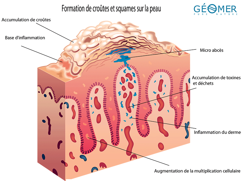 schéma de la création des croûtes de psoriasis