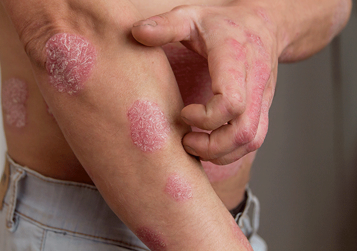 photo du psoriasis sur le bras d'un homme