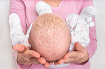 croûtes de lait sur la tête d'un bébé