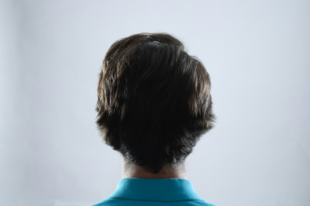 Chute de cheveux hormonale chez l'homme